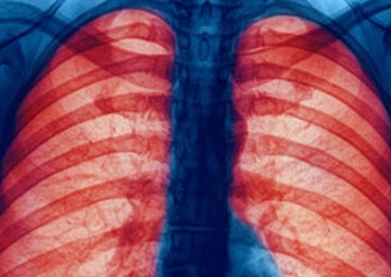 COPD Affects Approximately 16 Million Americans, Making Breathing Difficult
