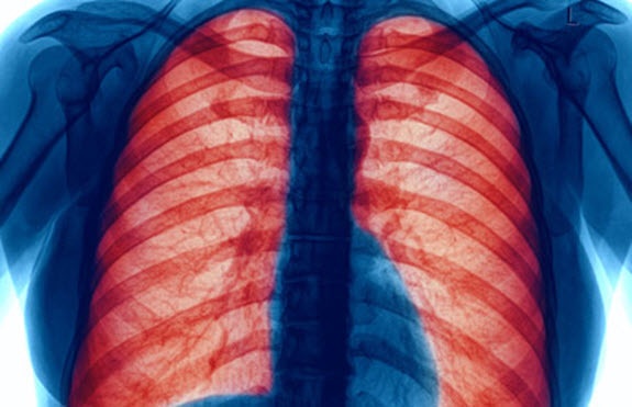 COPD Affects Approximately 16 Million Americans, Making Breathing Difficult