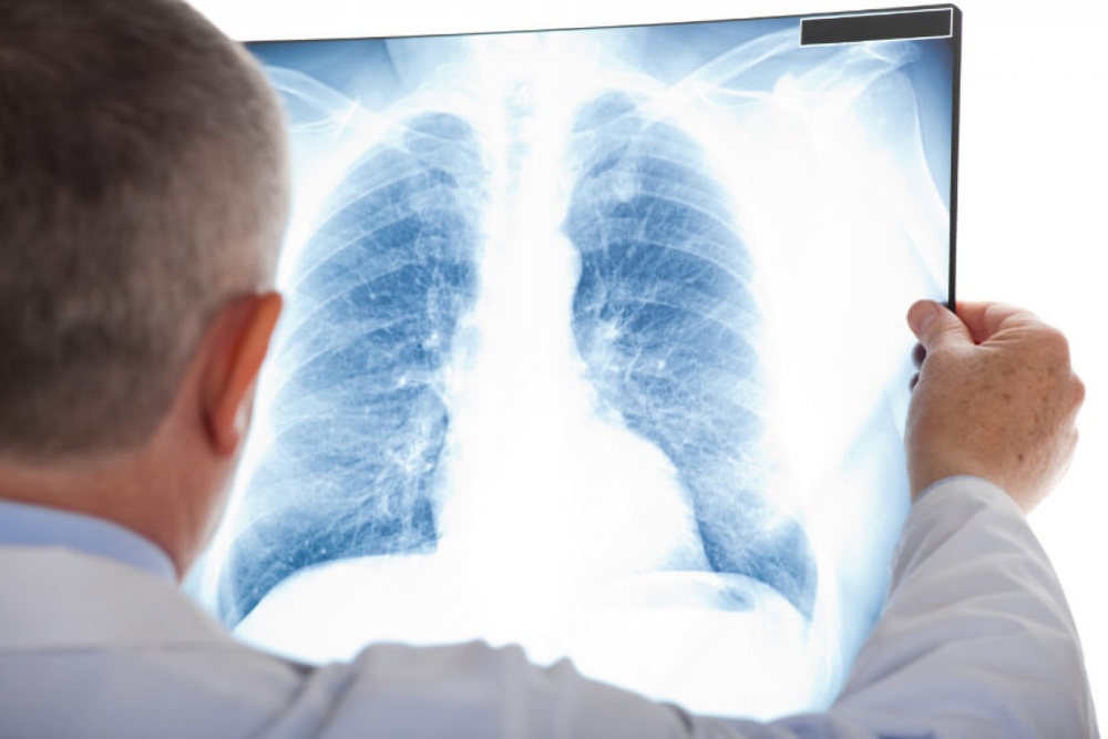 Lung Cancer Summit Highlights the Importance of Early Screening