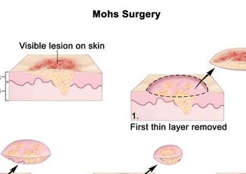Murtha Cancer Center hosts annual Skin Cancer Summit