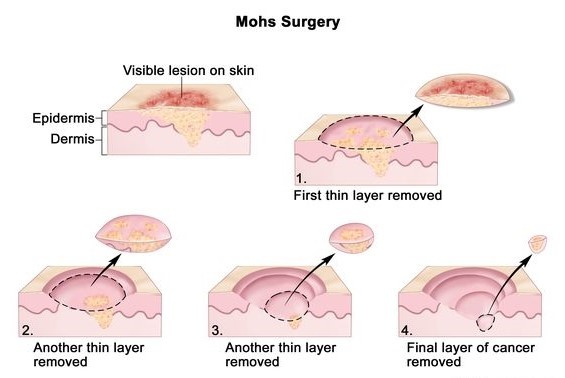 Murtha Cancer Center hosts annual Skin Cancer Summit