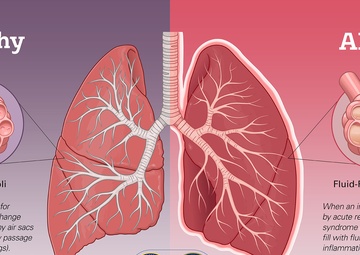 Respiratory Reinforcements