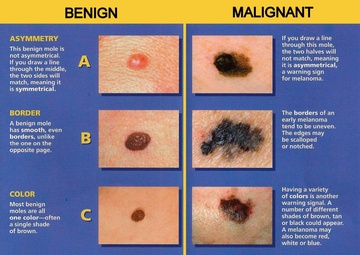 UV Safety Month: Walter Reed doctors urge people to protect their skin and eyes from sun’s dangerous UV rays