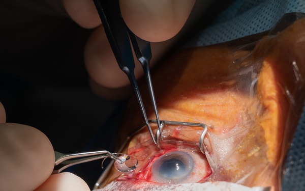 Surgeons Restore Sight and Forge Connections in Panama