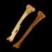 Normal tibia compared with tibia showing an antemortem fracture.