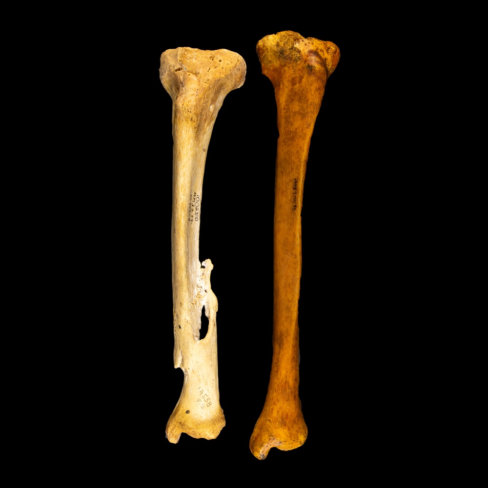 Normal tibia compared with tibia showing an antemortem fracture.