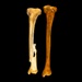 Normal tibia compared with tibia showing an antemortem fracture.
