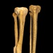 Normal tibia compared with tibia showing an antemortem fracture.