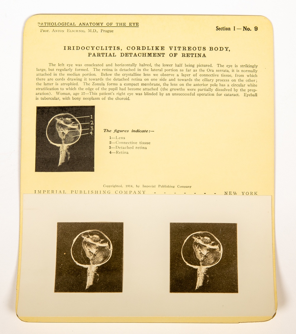 Stereogram from ‘Stereoscopic Studies: Pathological Anatomy of the Eye.’