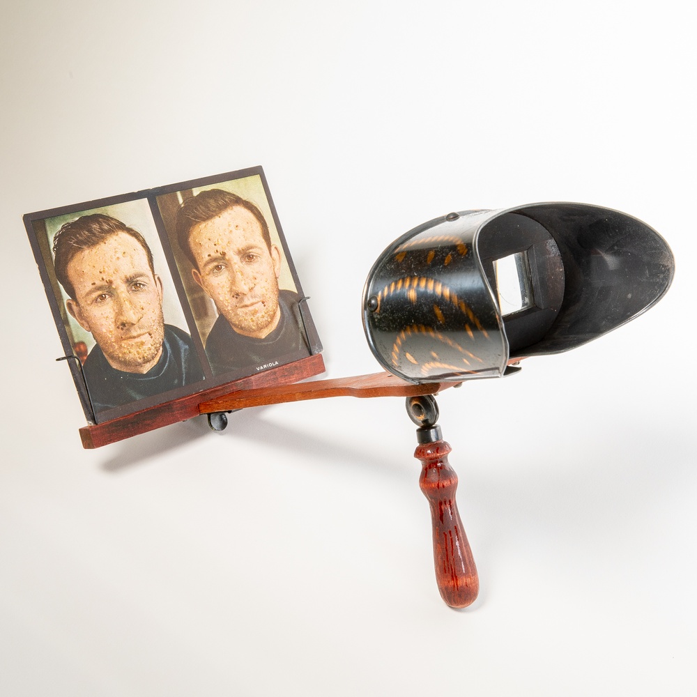 Stereoscope, with stereoscopic card, from The Stereoscopic Skin Clinic.’