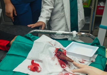 Honduran patient regains use of finger following successful operation by Navy Medicine surgeons