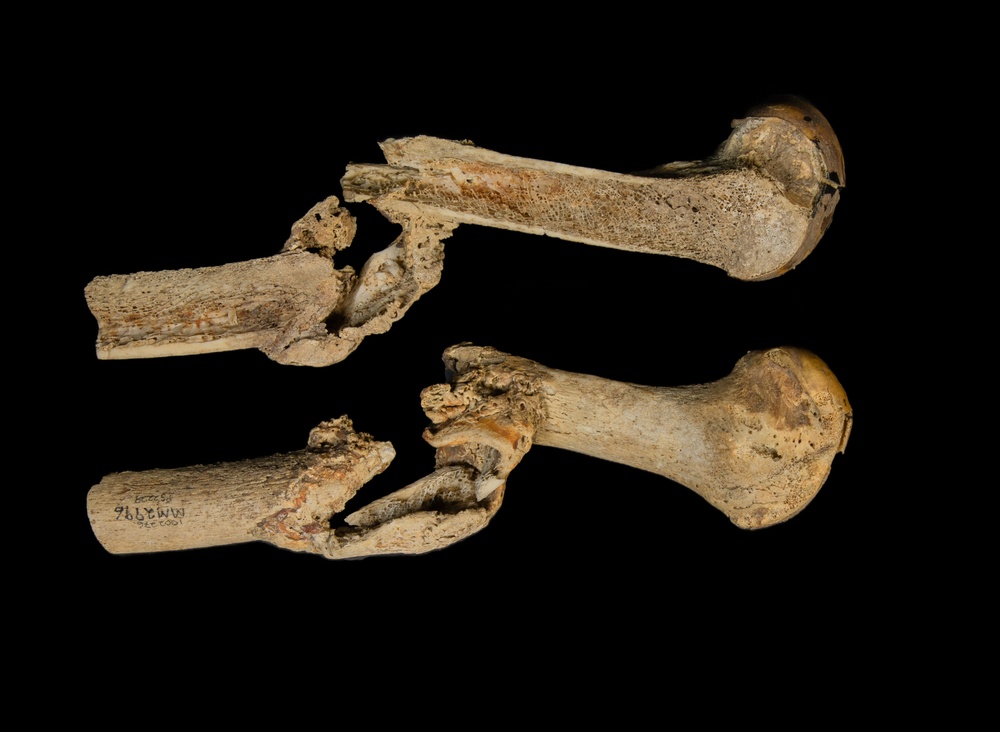 Femur, Osteomyelitis