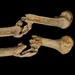 Femur, Osteomyelitis