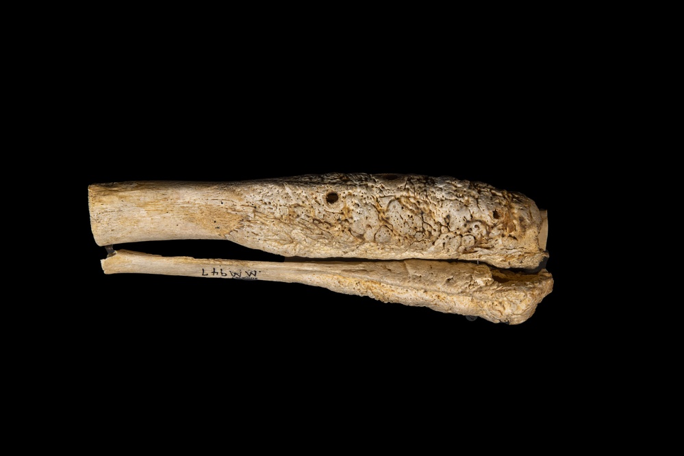 Tibia and Fibula, Osteomyelitis