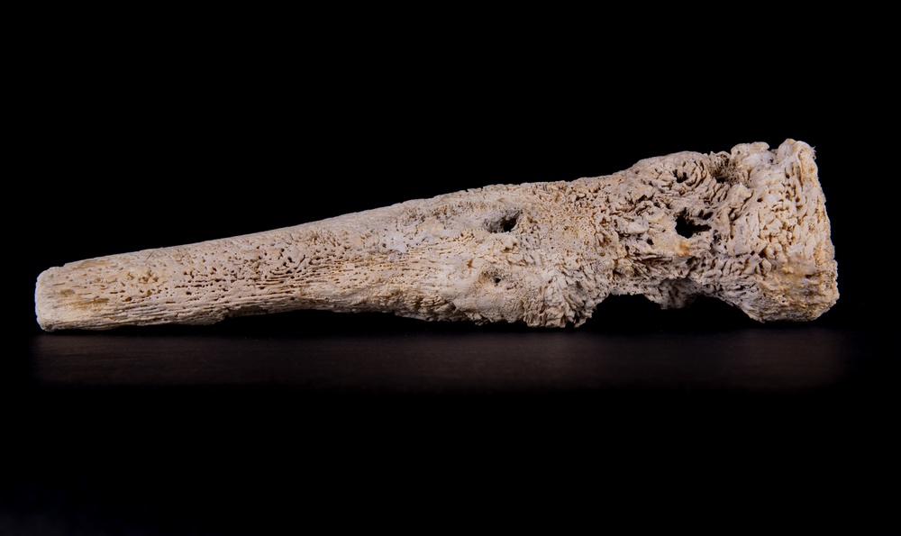 Tibia, Osteomyelitis