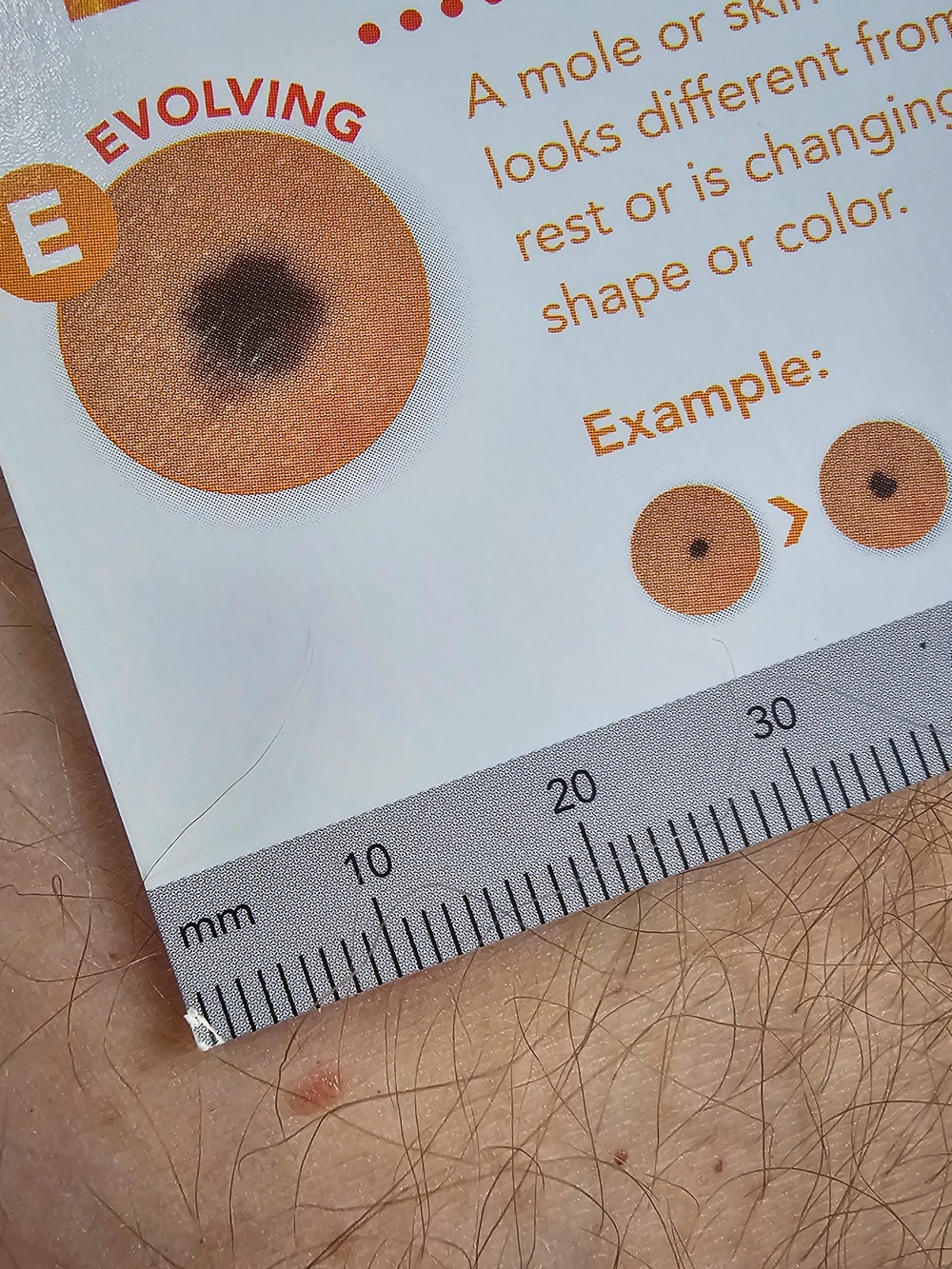 Skin Cancer Affects Everyone: Learn the Facts, Be Prepared