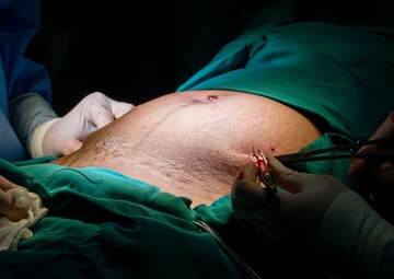 U.S. Air Force OBGYNs perform a laparoscopic bilateral salpingectomy during RS24