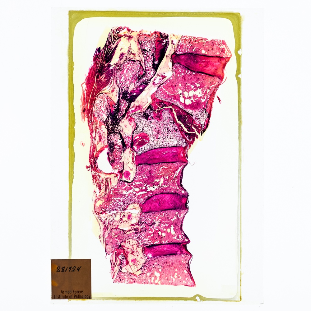 Orthopedic Pathology Histology Slide