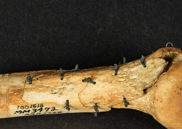 Civil War Gunshot Wound