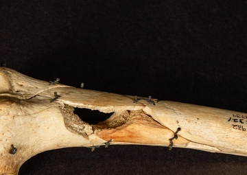 Civil War Gunshot Wound