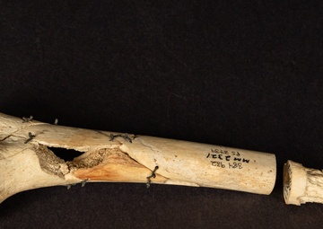 Civil War Gunshot Wound