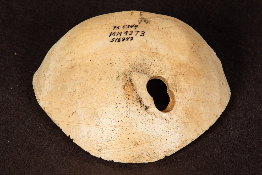 Civil War Gunshot Wound