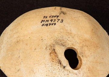 Civil War Gunshot Wound