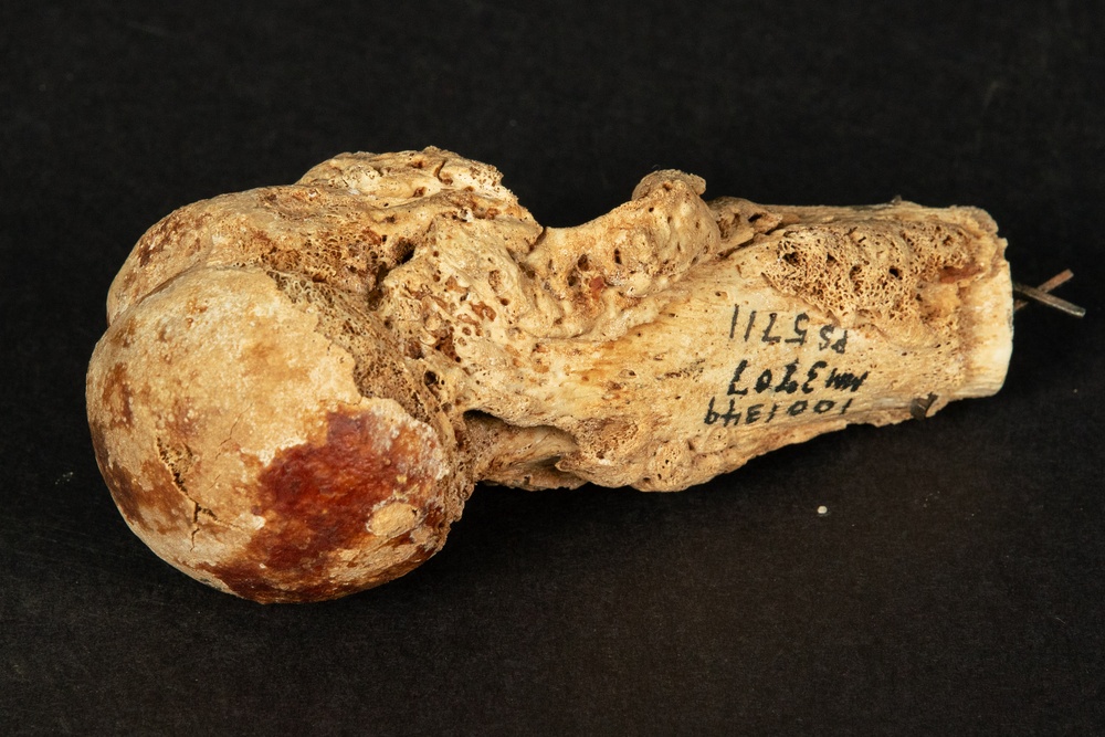 Civil War Gunshot Wound