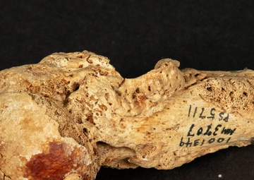 Civil War Gunshot Wound
