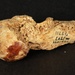 Civil War Gunshot Wound