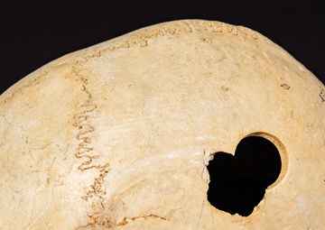 Civil War Gunshot Wound