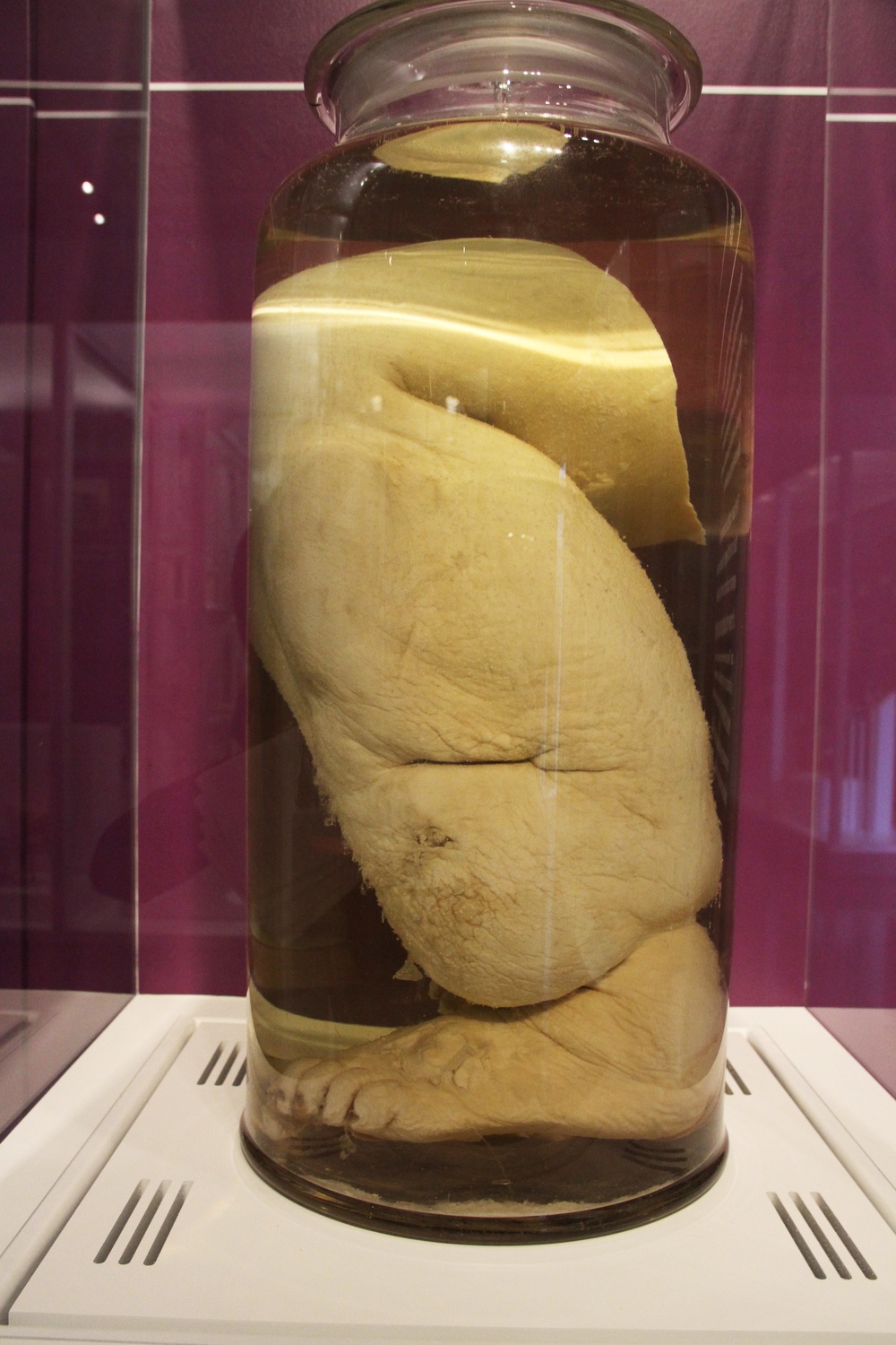 Amputated Leg Exhibit Highlights Elephantiasis at National Medical Museum