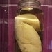 Amputated Leg Exhibit Highlights Elephantiasis at National Medical Museum