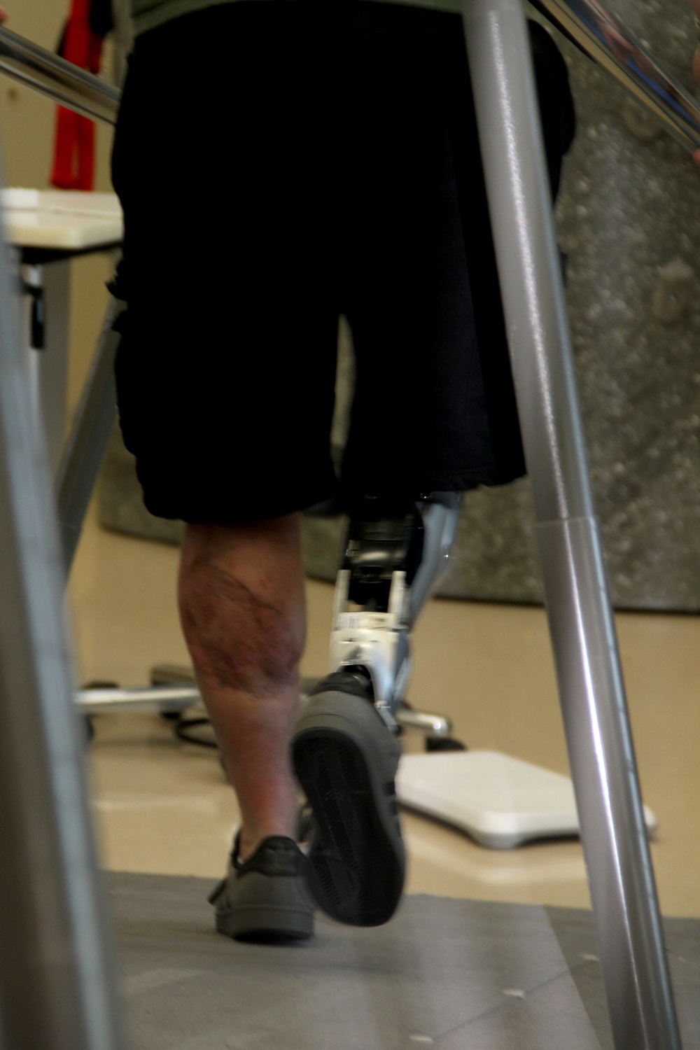 New Prosthetic Ankle and Foot Combination Allows Foot Flexion