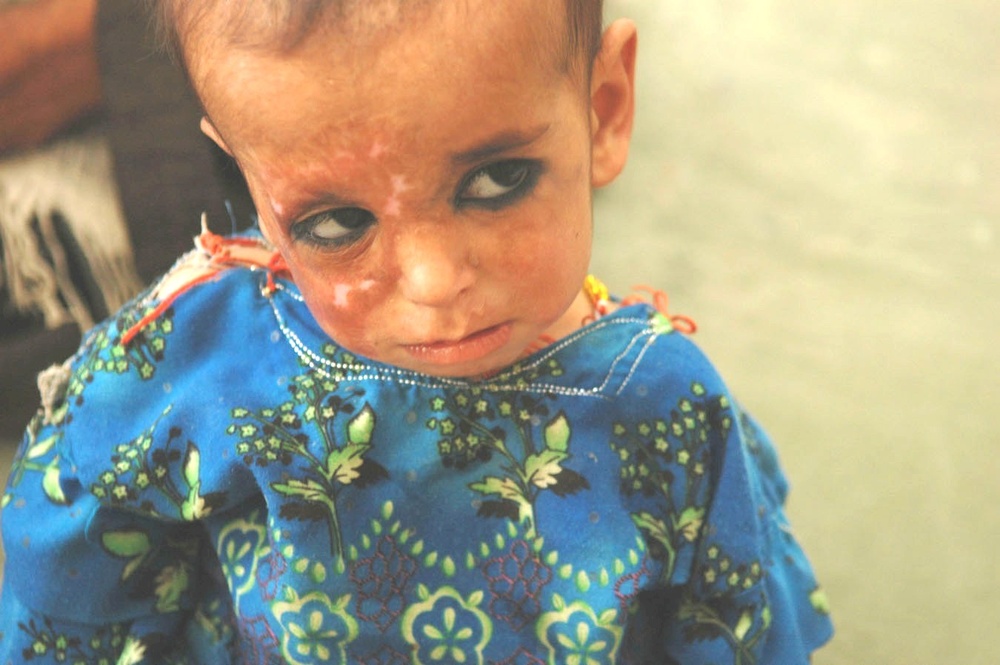 Afghan Child Receives Medical Care for Burn Scars