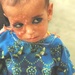 Afghan Child Receives Medical Care for Burn Scars