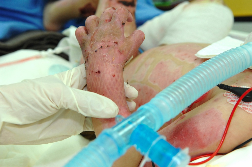 Iraqi Burn Victim, 3, to Receive Treatment in U.S.