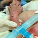 Iraqi Burn Victim, 3, to Receive Treatment in U.S.