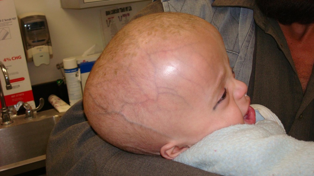 Afghan Girl Undergoes Successful Surgery for Arachnoid Cyst at Bagram Air Base