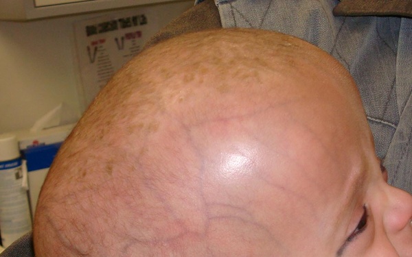 Afghan Girl Undergoes Successful Surgery for Arachnoid Cyst at Bagram Air Base