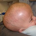 Afghan Girl Undergoes Successful Surgery for Arachnoid Cyst at Bagram Air Base
