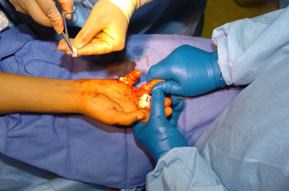 Army Surgeon Performs Life-Changing Skin Graft for Afghan Man