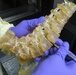 3D Printing Revolutionizes Spinal Surgery at Walter Reed