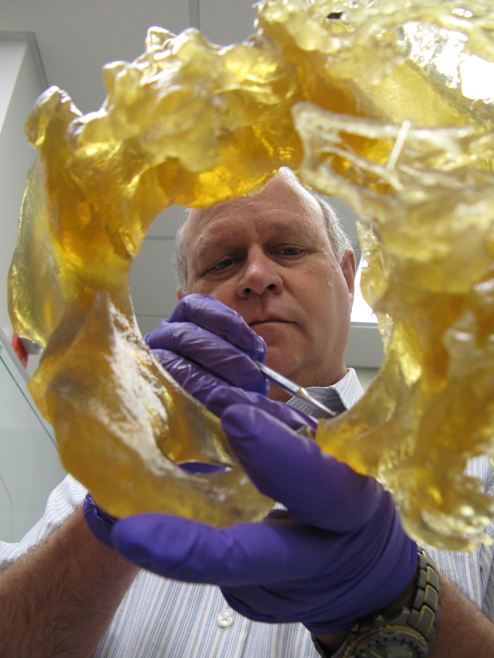 3-D Imaging Helps Surgeons Tackle Challenging Bone Growth in Amputees
