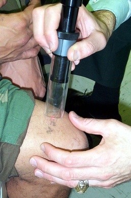 Army Doctor Removes Tattoo from Soldier's Knee Using Laser