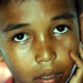 Indonesian Boy Receives Dental Care, Avoids Tooth Extraction