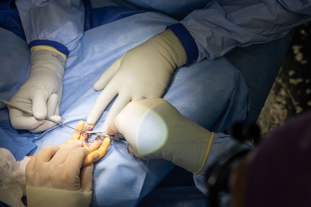 CP25 Syndactyly Surgery Ecuador