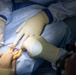 CP25 Syndactyly Surgery Ecuador