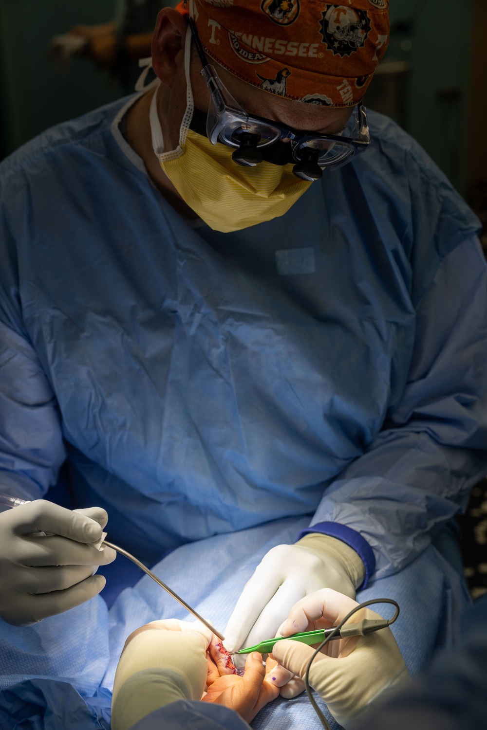 CP25 Syndactyly Surgery Ecuador