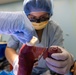 CP25 Syndactyly Surgery Ecuador